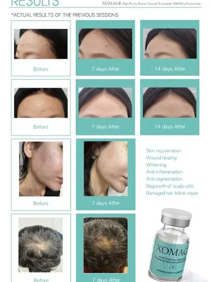 This image shows the actual before-and-after results from XOMAGE Exosome sessions for both skin and hair. You can see a noticeable improvement in hair density after just a few weeks.