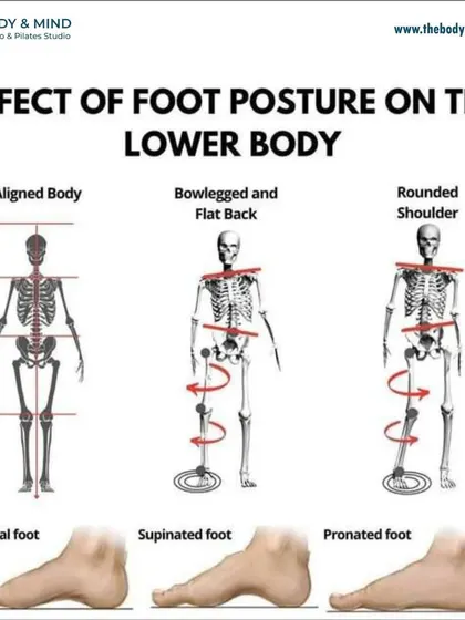 Your foot posture is the foundation for your entire body. This diagram shows how a pronated (flat) or supinated (high-arched) foot can lead to misalignments in the knees, hips, and spine, causing pain elsewhere in the body.