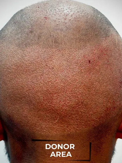This image shows the donor area on the back of the head immediately after a 4600-graft extraction. My technique ensures that we harvest grafts evenly to avoid any patchy look as it heals.