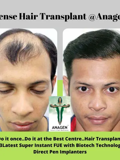 "Do it once..Do it at the Best Centre." This before and after photo shows a dense hair transplant result that justifies our motto.