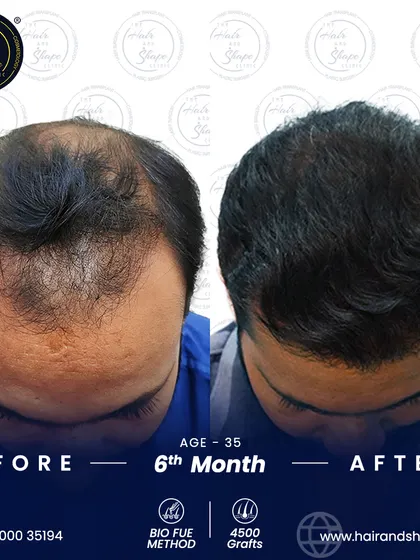 A top-down view at 6 months, demonstrating the extensive coverage and density achieved with the BIO FUE technique.