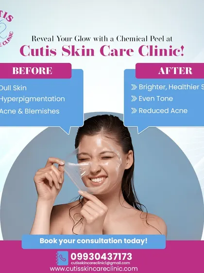 This graphic clearly shows the transformative effects of a chemical peel. I use peels to address issues like dullness, hyperpigmentation, and acne. The 'after' state shows what you can expect: brighter, healthier skin with a more even tone and reduced blemishes.