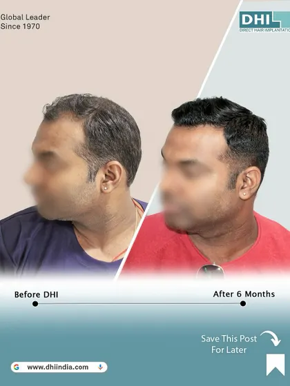 Another side-profile view of the 6-month transformation. This angle showcases the seamless integration of the new hair, creating a natural and aesthetically pleasing result.
