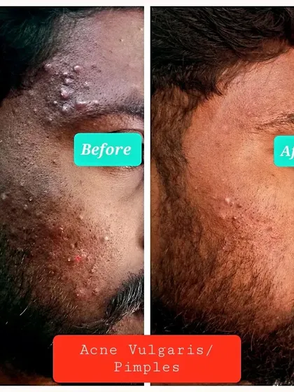 A closer look at the progress made in treating acne vulgaris. Reducing inflammation and preventing new lesions are the first steps toward clear skin and scar prevention.