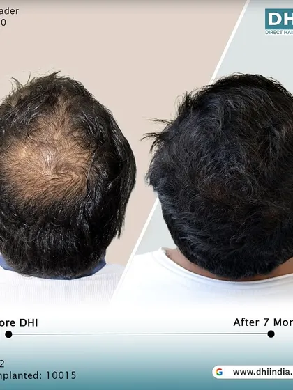 A top-down view of the same client's 7-month progress. This image clearly shows the significant improvement in coverage and density across the scalp, demonstrating the effectiveness of our DHI procedure.