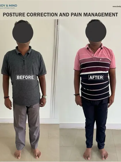 This before-and-after image showcases a real client's postural transformation. Through a targeted program combining physiotherapy and Pilates, we were able to realign his spine, reduce chronic pain, and improve his overall stability and function.