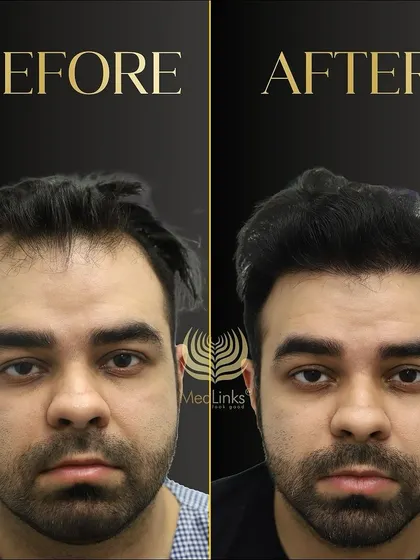 A great before and after transformation. The patient's new hair looks natural, dense, and has completely revitalized his appearance.
