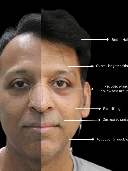 Skincare is for everyone. This patient's transformation journey focused on facial rejuvenation to combat sun damage and dehydration. We used a combination of skin tightening procedures and modulators to achieve a brighter skin tone, reduced wrinkles, and an overall lifted, more youthful appearance.