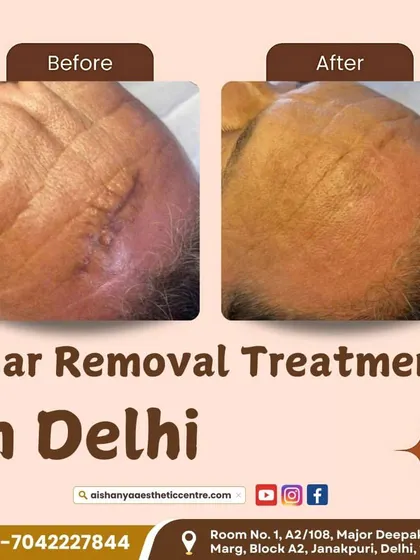 This before-and-after demonstrates a successful scar removal treatment on the forehead. The treatment significantly flattened and faded the scar, blending it with the surrounding skin for a much less noticeable appearance.