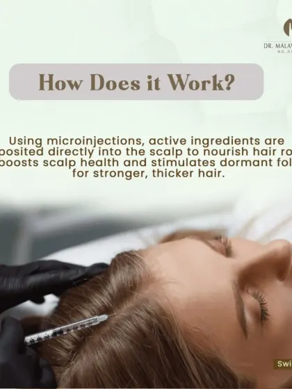 This image details the mechanism of Hair Mesotherapy. Using microinjections, I deposit a customized blend of active ingredients directly into the scalp to nourish hair roots, boost scalp health, and stimulate dormant follicles for stronger, thicker hair.