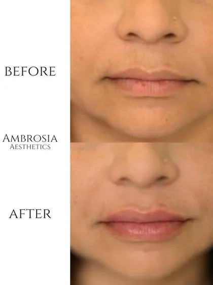 Here is another example of my approach to lip fillers. The goal was to create a fuller, more hydrated pout that remains proportionate and enhances the patient's smile naturally.