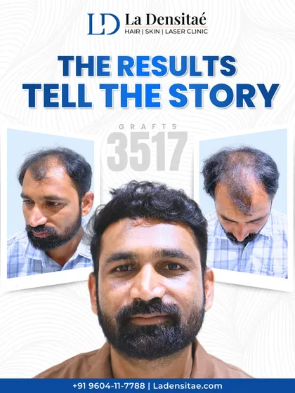 This transformation is the result of precision and patience. With 3,517 grafts implanted using my RT-FUE technique, the goal was to make it look like nothing was ever done, just a return to a natural, fuller head of hair.