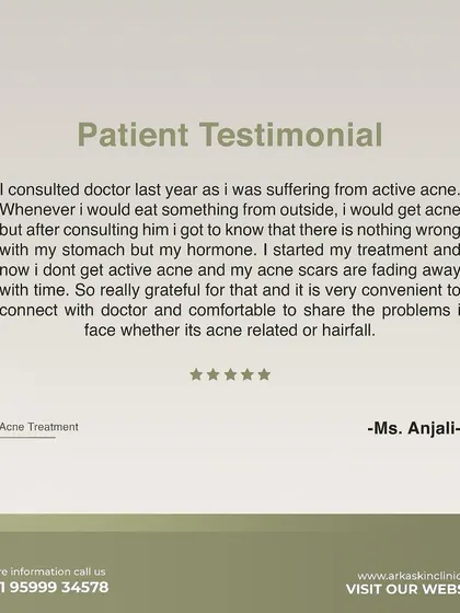 This testimonial from Ms. Anjali details her journey with hormonal acne. She explains how we identified the root cause and how her skin is now free of active acne, with scars fading. Her experience highlights the importance of a correct diagnosis.