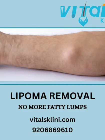 An illustration of a lipoma, a common fatty lump under the skin. I perform lipoma removal through surgical excision, ensuring the entire growth is removed safely in our dedicated operating theatre.