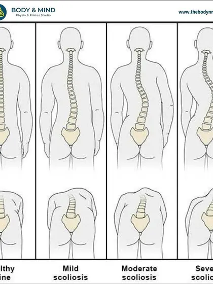 This visual guide shows the different degrees of spinal curvature in scoliosis. My role is to provide conservative management through exercises that promote better alignment and core stability.