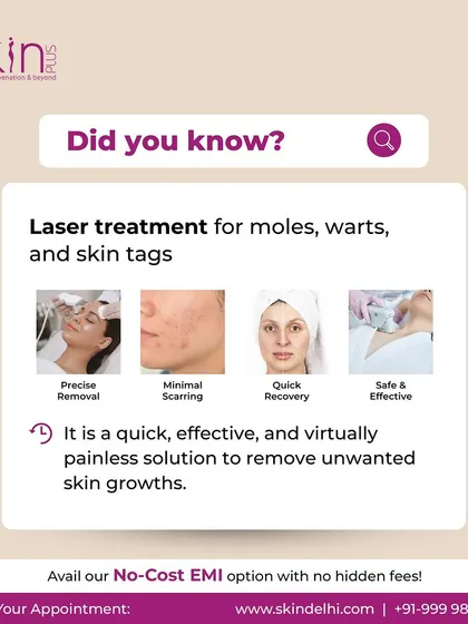 A "Did you know?" graphic explaining that laser treatment for moles, warts, and skin tags is a quick, effective, and virtually painless solution with minimal scarring and quick recovery.