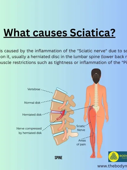 A duplicate of the causes of sciatica infographic.