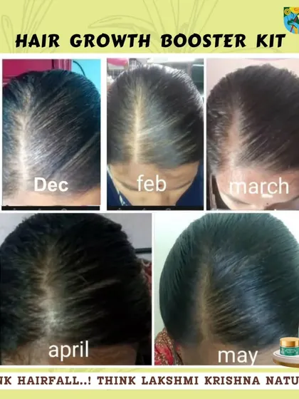 This before-and-after collage shows the real progress a customer made using our Hair Growth Booster Kit over several months. You can see the gradual but significant improvement in hair density from December to May. Think hair fall, think Lakshmi Krishna Naturals.