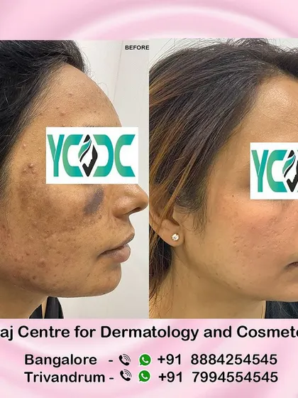 This is another angle of the patient whose skin I treated for post-inflammatory hyperpigmentation caused by a botched procedure. It highlights the importance of seeking care from a board-certified dermatologist.