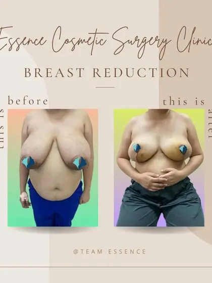 A straightforward before-and-after of a breast reduction surgery. The 'after' photo clearly shows a significant decrease in breast volume, resulting in a more proportionate and comfortable chest for the patient.