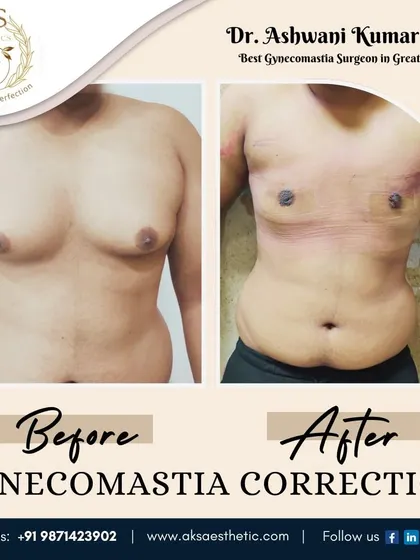This before and after image highlights the transformative effect of gynecomastia surgery. The post-surgery photo shows a well-defined, flatter chest, restoring a natural and masculine contour.