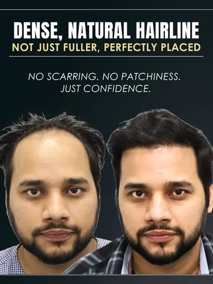 The final result is a dense, natural hairline that is perfectly placed. There is no scarring or patchiness, just a confident new look.