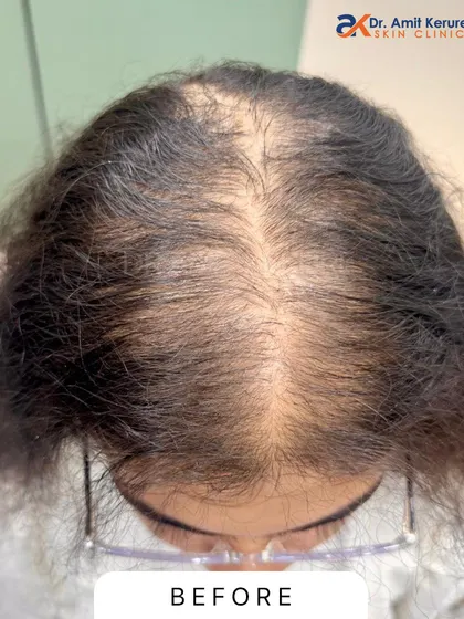This is the 'before' photo of a patient with significant hair thinning and a wide partition, a classic sign of female pattern hair loss. This is the starting point from which we measure progress.