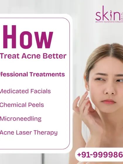 An infographic listing professional treatments for acne. It includes Medicated Facials, Chemical Peels, Microneedling, and Acne Laser Therapy as effective solutions beyond home remedies.