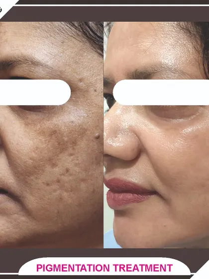 A side profile view of our pigmentation treatment results, showing a dramatic improvement in skin clarity and tone.