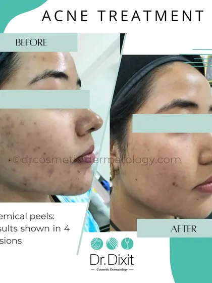 This transformation was achieved with a series of four carefully selected chemical peels. Peels are an excellent way to manage active acne and reduce post-inflammatory hyperpigmentation by exfoliating the skin and unclogging pores, revealing a brighter, more even complexion.