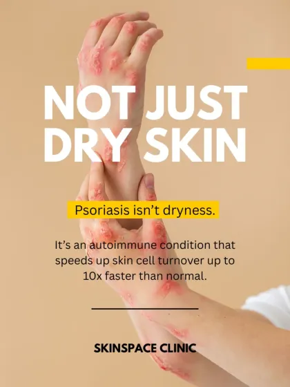 Psoriasis is fundamentally different from dry skin. It is an internal autoimmune process where skin cell turnover is up to 10 times faster than normal, requiring a medical approach to treatment.