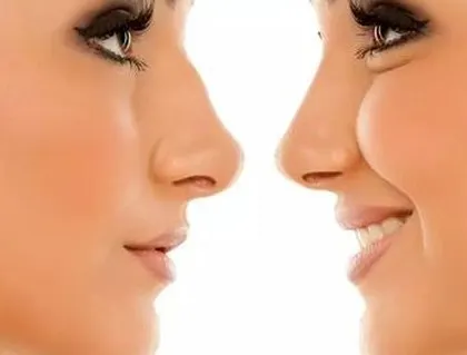 Whether for cosmetic or functional reasons, rhinoplasty can be a transformative experience. A consultation is the first step to understanding what is possible for you.