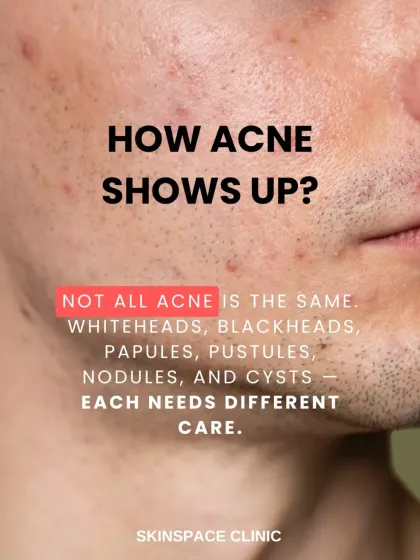 Acne shows up in many forms, from whiteheads and blackheads to more severe nodules and cysts. Each type requires a different treatment approach, which is why a professional diagnosis is so important.
