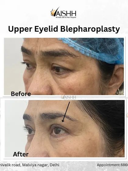 A side profile view showing the results of an upper eyelid surgery. The lift is natural and enhances the patient's features without looking overdone.