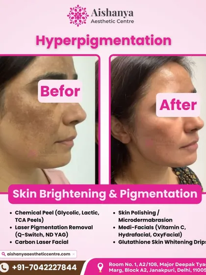 Hyperpigmentation can be challenging, but with the right approach, it is treatable. This before-and-after shows a significant lightening of dark patches, leading to a more uniform and radiant skin tone.