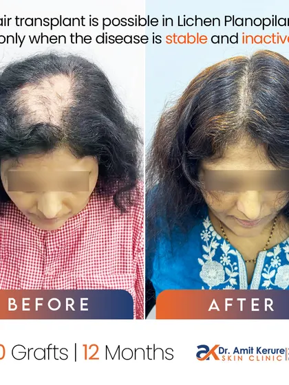 A direct before and after comparison of the Lichen Planopilaris case. It highlights the core principle that a hair transplant is only possible in such conditions when the disease is stable and inactive.
