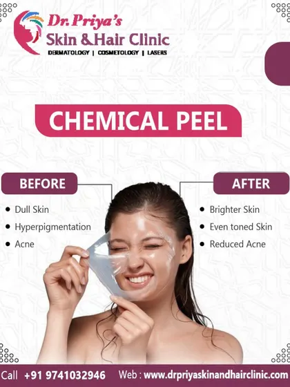 A chemical peel can transform dull skin, hyperpigmentation, and acne into a brighter, even-toned, and clearer complexion. This image shows the peeling process, revealing renewed skin underneath.