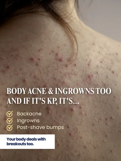 Acne isn't limited to the face. Body acne, or "backne," along with ingrown hairs and post-shave bumps, are very common. I also treat conditions like Keratosis Pilaris, often called "strawberry skin," which causes rough bumps on the arms and legs.