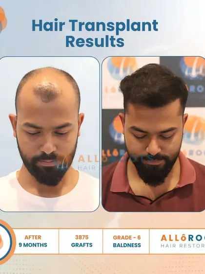This 9-month result for a Grade 6 baldness case, achieved with 3875 grafts, is a testament to what is possible even in advanced stages of hair loss. The transformation is comprehensive and natural.