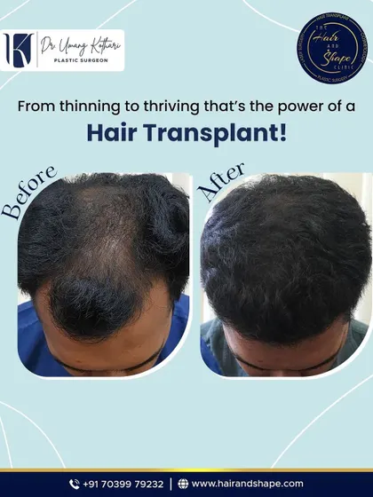 From thinning to thriving. This before and after demonstrates how a hair transplant can bring back a full, healthy head of hair.