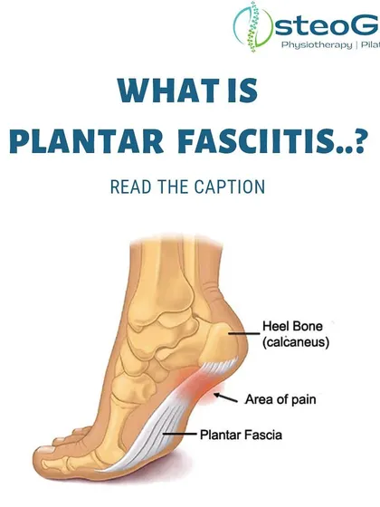 This diagram explains Plantar Fasciitis, a common cause of stabbing heel pain. It shows the plantar fascia, the tissue band that becomes inflamed, and the typical area of pain.