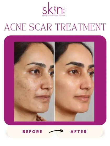 This before-and-after image highlights the success of my targeted acne scar treatments. You can see a dramatic improvement in skin smoothness and a reduction in the depth and discoloration of scars.