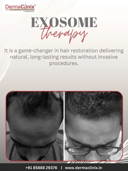 This before-and-after image shows the results of Exosome therapy, a game-changer in hair restoration that delivers natural, long-lasting results without invasive procedures.