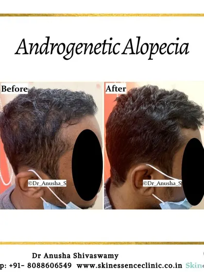 Here is a clear example of treating androgenetic alopecia, focusing on a receding hairline. The 'after' photo shows a noticeable restoration of the hairline and increased thickness in the temple area, achieved through a personalized treatment plan.