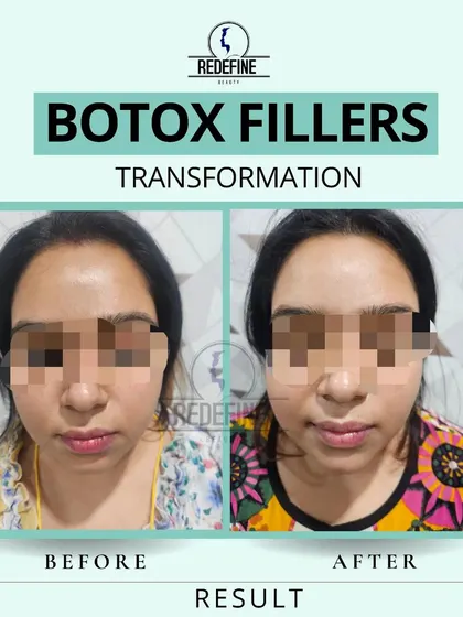 This client was looking for overall facial rejuvenation. By using a combination of Botox and dermal fillers, I was able to soften lines and restore volume, resulting in a fresher, more rested appearance. This is a perfect example of a non-surgical transformation.