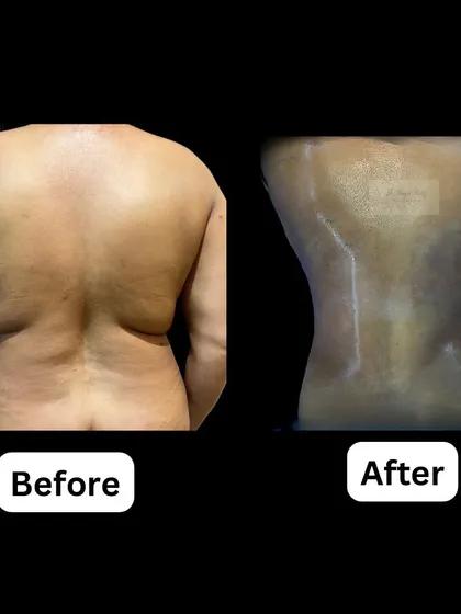 This before and after shows a waistline restoration using Vaser liposuction and BodyTite. This combination allows us to precisely remove fat from the back and flanks while tightening the skin, creating a more defined and sculpted silhouette.