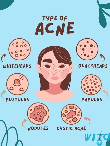 Understanding the type of acne you have, from whiteheads to cystic acne, is the first step toward effective treatment. This guide illustrates the different forms, each requiring a unique therapeutic approach.