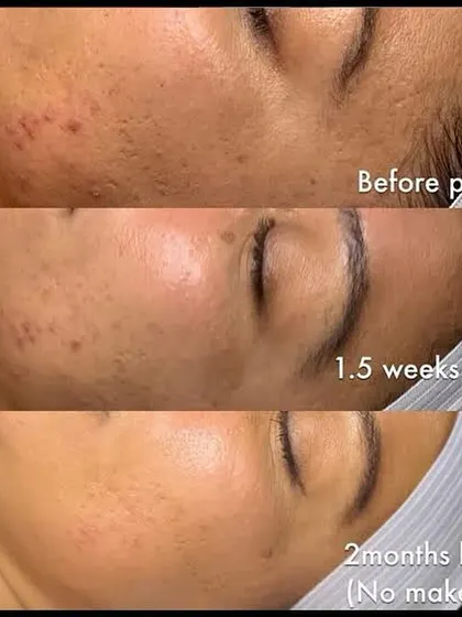 This before and after sequence shows the power of our chemical peel treatments over two months. You can see a significant reduction in acne, scarring, and pigmentation, revealing smoother, clearer skin.