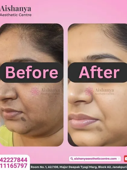Pigmentation and uneven skin tone are very common concerns, but they don't have to be permanent. This before and after showcases the significant clearing of dark spots and melasma, resulting in a much brighter and more even complexion.