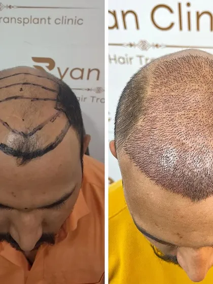 Before and after the hair transplant procedure. The hairline is marked and designed, and then the area is filled with high density grafts for a complete transformation.